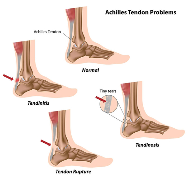 Achilles Tendon Problems 